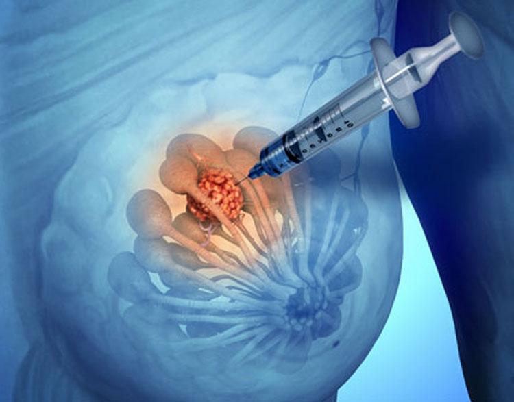 Симптомы и методы лечения кисты молочной железы