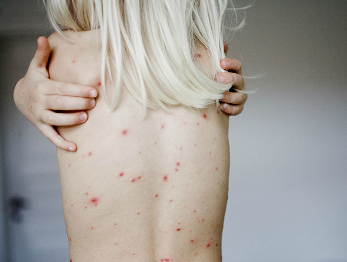 Специфические и неспецифические симптомы сифилиса