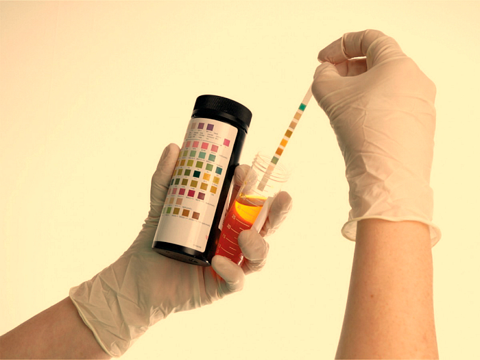 О чем сигнализирует появление эритроцитов в моче?