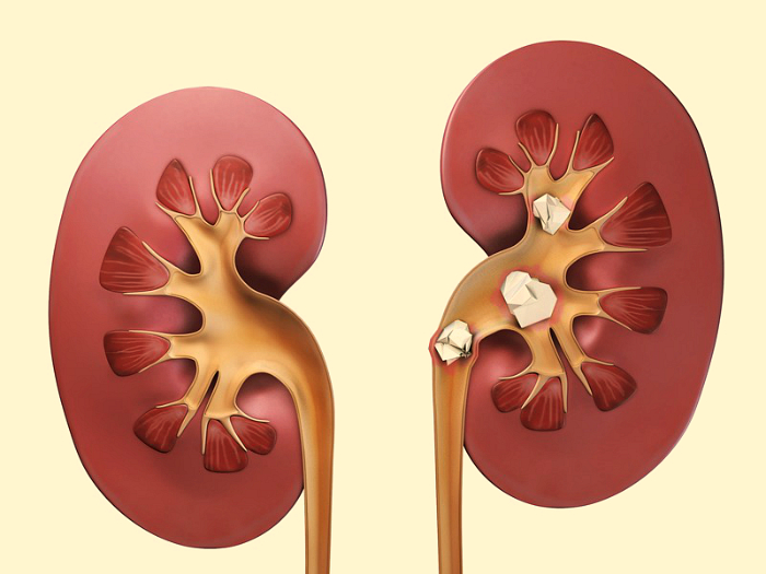 Чем опасно образование песка в почках и как от него избавиться?