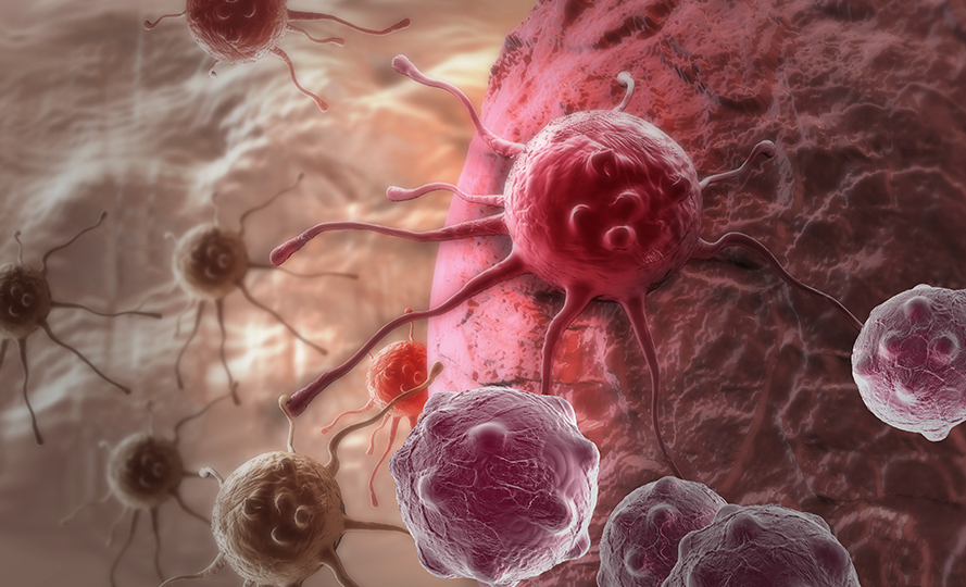 Что из себя представляет и чем опасна аденокарцинома матки?