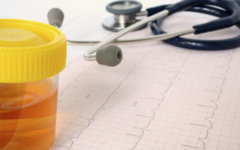 О чем может говорить темно-желтая моча у мужчин и женщин?