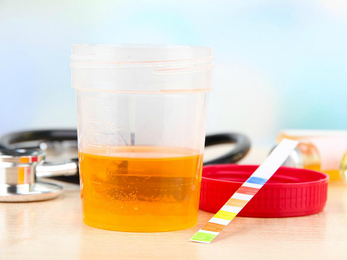 Основные причины изменения цвета мочи у человека