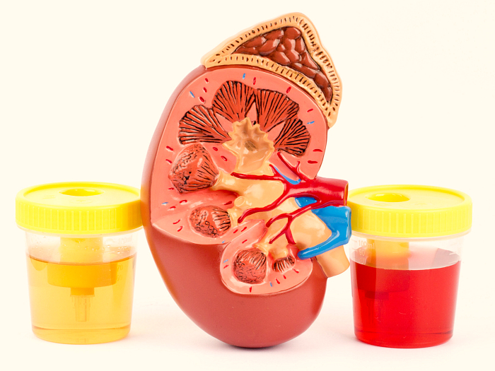 Гематурия (эритроцитурия) — это норма или патология?
