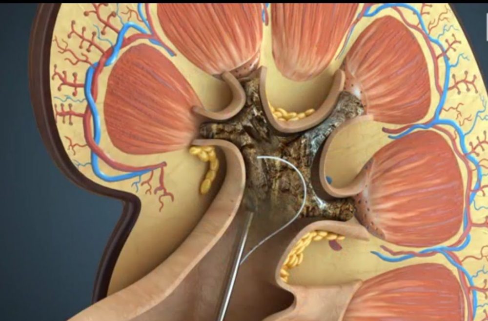 Основные причины и методы лечения солевого диатеза почек