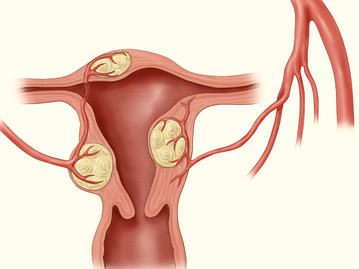 Современные методы лечения интерстициальных миом матки