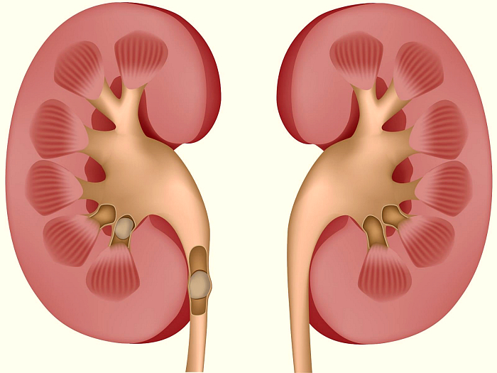 Народные методы лечения и медикаментозные лекарства от камней в почках