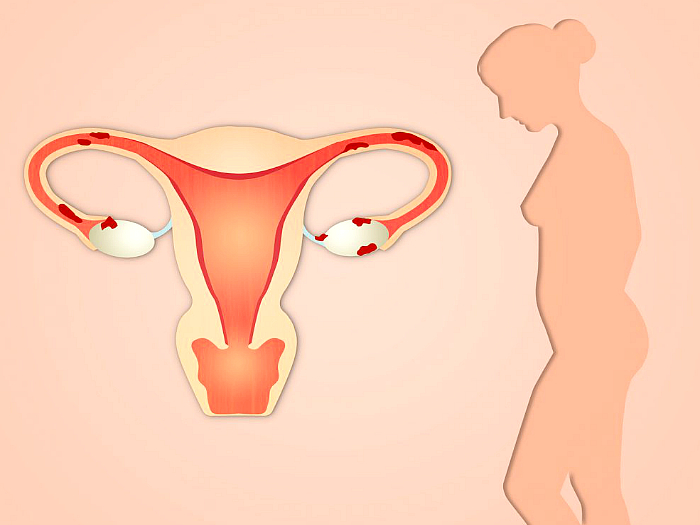 Патологии эндометрия матки: болезни и лечение