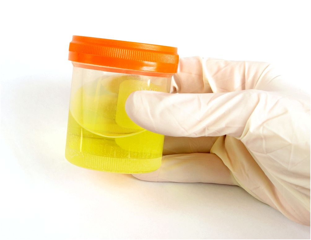 Заболевания на фоне повышенного количества уратов в моче, причины и профилактика