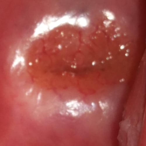 Лечение гиперплазии эндометрия методом ФДТ, Гинеколог Герасимова Ольга