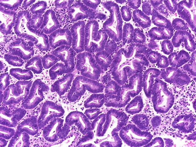 Как лечат гиперплазию эндометрия: симптомы, необходимая диагностика, методы лечения, обзор препаратов, отзывы