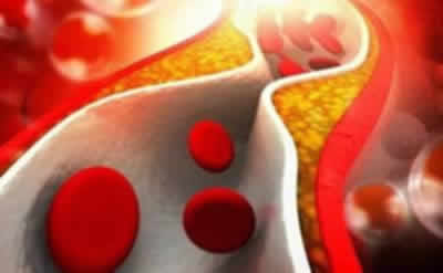 Как быстро снизить холестерин в крови, таблетки, травы, продукты снижающие холестерин