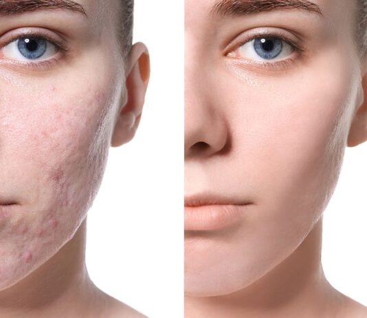 Средство Ферменкол для рубцов: что это, фармакодинамика, показания, противопоказания, особенности и плюсы использования