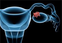 Лечение рака яичников — современные стандарты