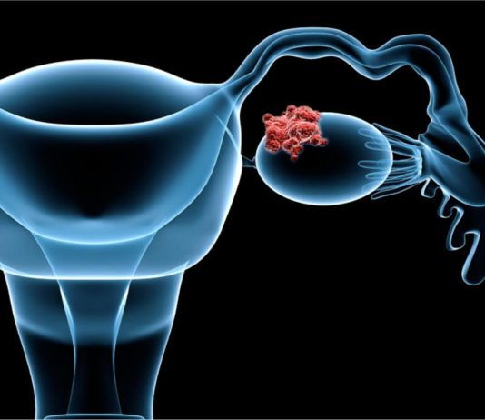 Лечение рака яичников — современные стандарты
