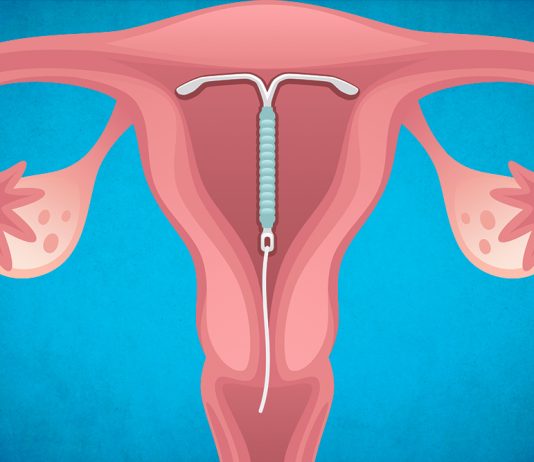 Как ставится ВМС
