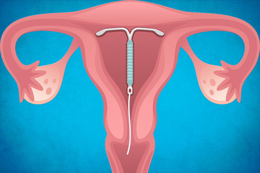 Как ставится спираль женщинам против беременности фото