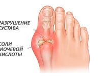 Для лечения подагры – Колхицин Лирка!