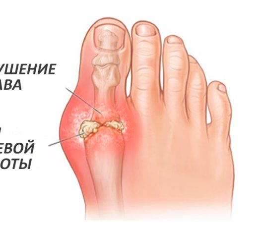 Для лечения подагры – Колхицин Лирка!