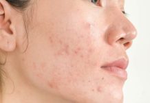 Прыщи после месячных: причины возникновения таких высыпаний