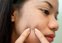 Проблема каждой девочки-подростка: высыпания на лице во время месячных