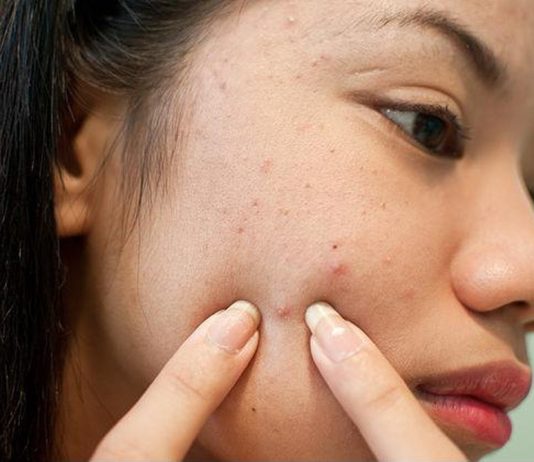 Проблема каждой девочки-подростка: высыпания на лице во время месячных