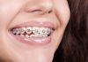 Современные брекет-системы и исправление неправильного прикуса: принцип работы и виды
