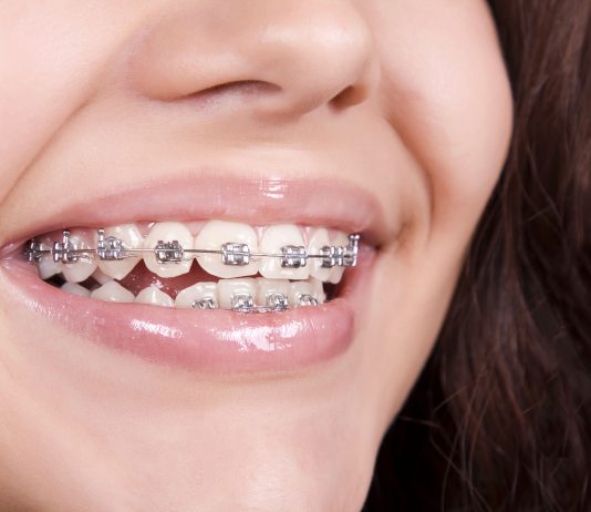 Современные брекет-системы и исправление неправильного прикуса: принцип работы и виды