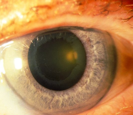 Глаукома и ее эффективное лечение лазером: новые перспективы