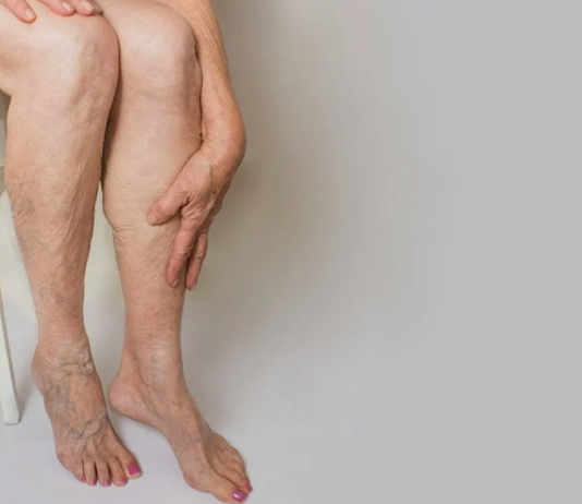 Операция удаления варикоза: все, что нужно знать