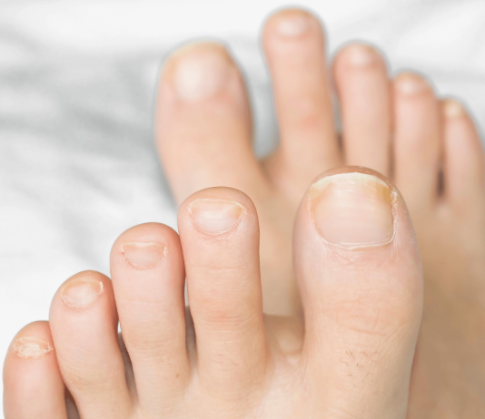 Лекарство от грибка ногтей. Проверенные и новые препараты 2024 года