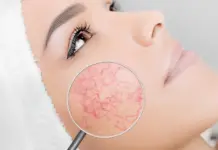 Сосуды на коже: как удалить их с лица