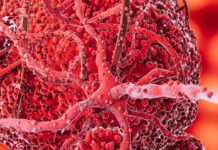 Лечение опухоли мозга гамма-ножом: как это происходит