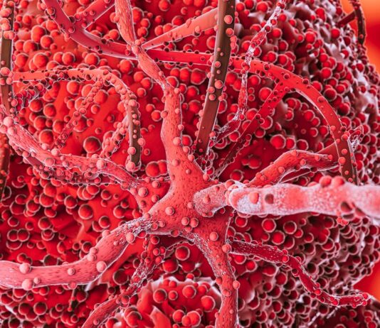 Лечение опухоли мозга гамма-ножом: как это происходит