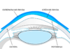 Склеральные линзы: не опасны ли такие линзы для глаз