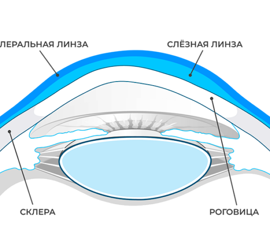 Склеральные линзы: не опасны ли такие линзы для глаз