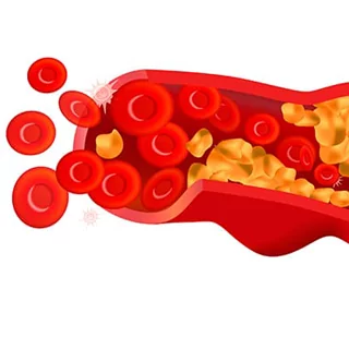 Хирургические методы лечения атеросклероза