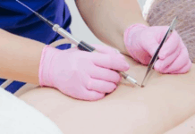 Удаление папиллом лазером в Санкт-Петербурге: эффективное и безопасное решение