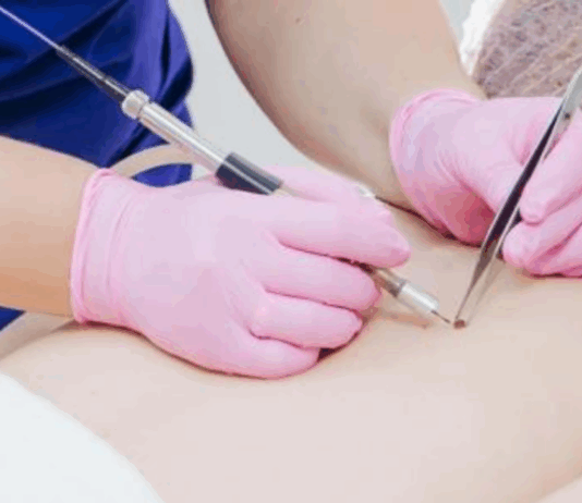 Удаление папиллом лазером в Санкт-Петербурге: эффективное и безопасное решение