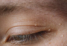 Папиллома на верхнем веке: причины, симптомы и методы удаления
