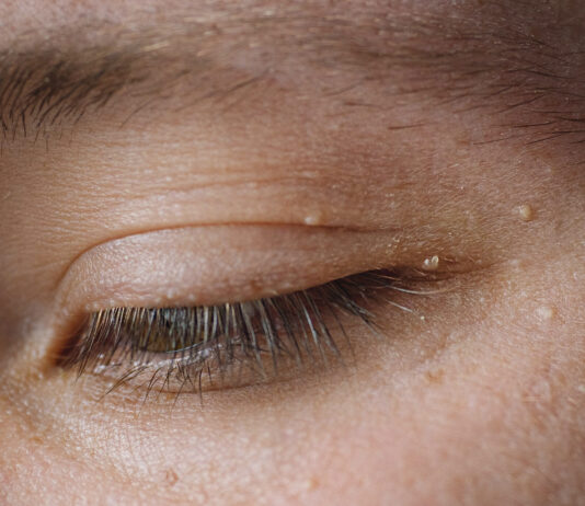 Папиллома на верхнем веке: причины, симптомы и методы удаления